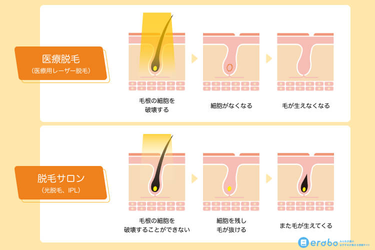 コスパ順 メンズ脱毛のおすすめランキング 安くて効果の高い脱毛サロンの選び方 Erabo えらぼ みんなが選ぶ おすすめが集まる情報サイト